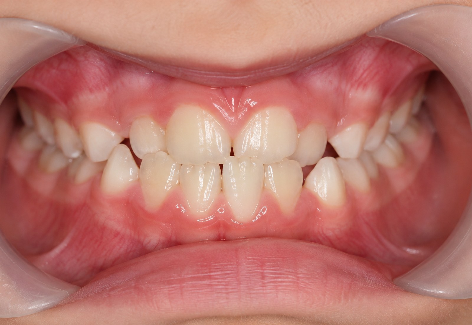 A close-up clinical view of a child's front teeth showing crowding and overlapping